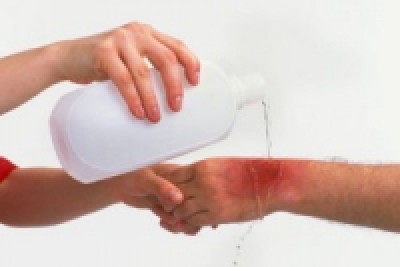 How to give first aid when you are burned by fire and explosion you need to know